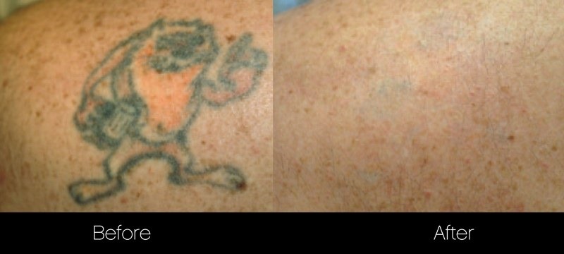 affinity u0026 accolade alexandrite laser tattoo removal toronto affinity u0026 accolade alexandrite laser tattoo removal toronto