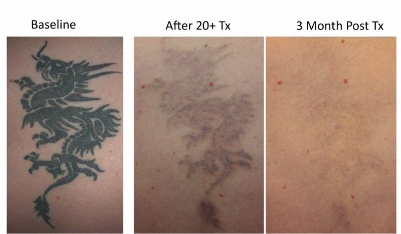 laser tattoo removal in toronto on spamedica toronto laser tattoo removal in toronto on spamedica toronto