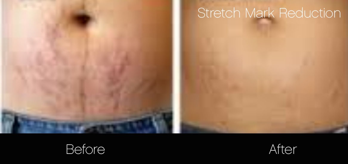 Makeup For Stretch Marks On Stomach Makeup Vidalondon