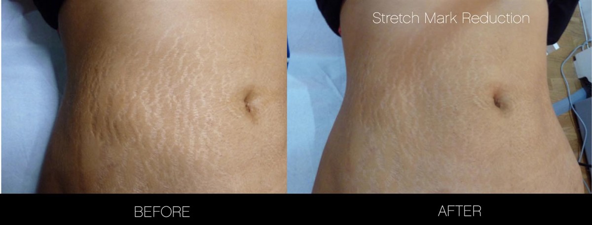 Lovely Stretch Marks Before And After Weight Loss Men ...