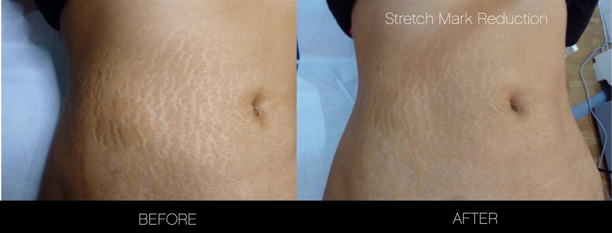 Lovely Stretch Marks Before And After Weight Loss Men - wallpaper craft